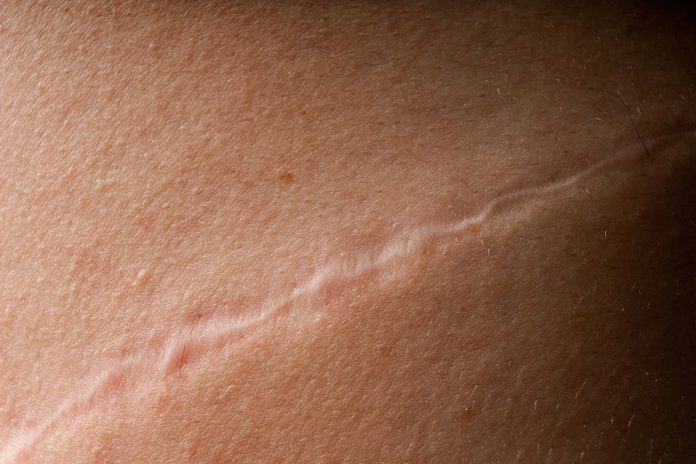 estudo:-proteina-ligada-ao-cancer-ajuda-a-cicatrizar-feridas-na-pele